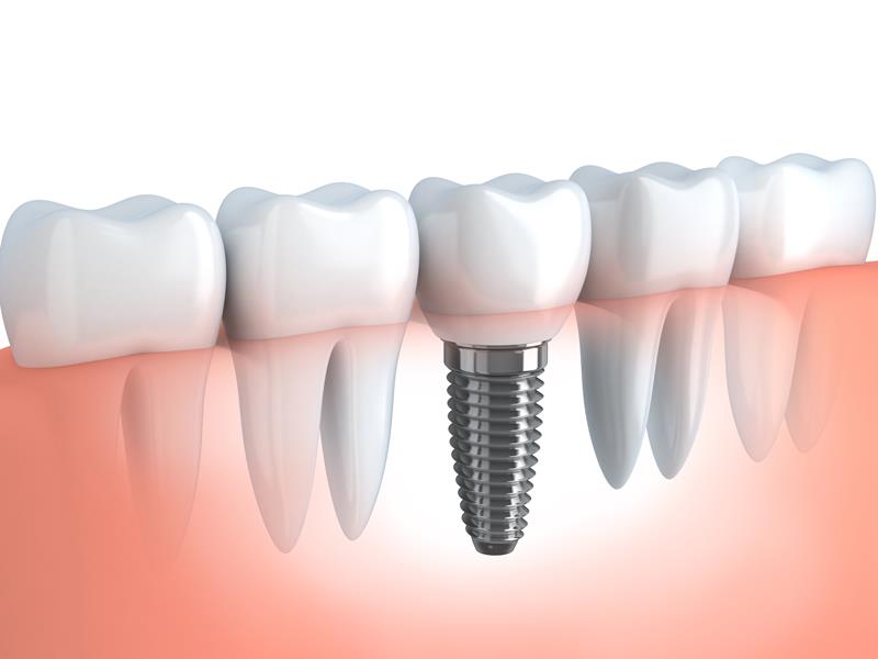 Dental Implants  Modesto, CA 